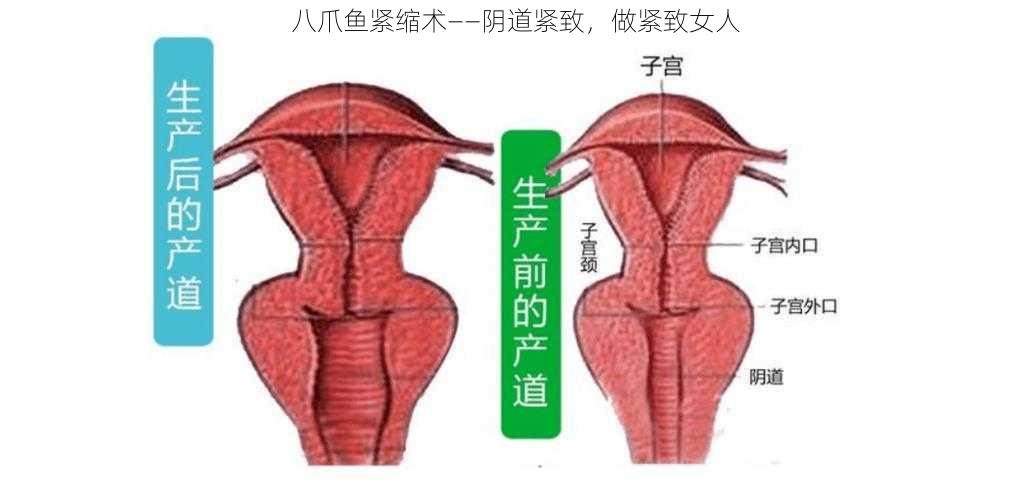 八爪鱼紧缩术——阴道紧致，做紧致女人